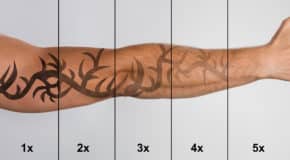 Le détatouage : quand l’encre devient has-been